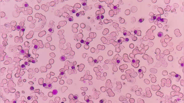al1What is Alpha Thalassemia? How is it diagnosed?