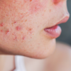 Skin issues (Rashes or dullness)