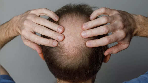 Baldness and coronary heart disease