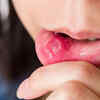 Canker sores
