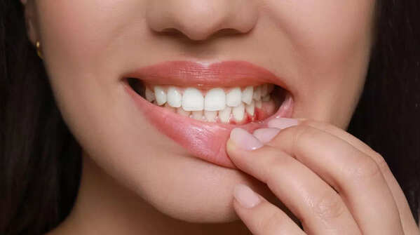 Bleeding gums