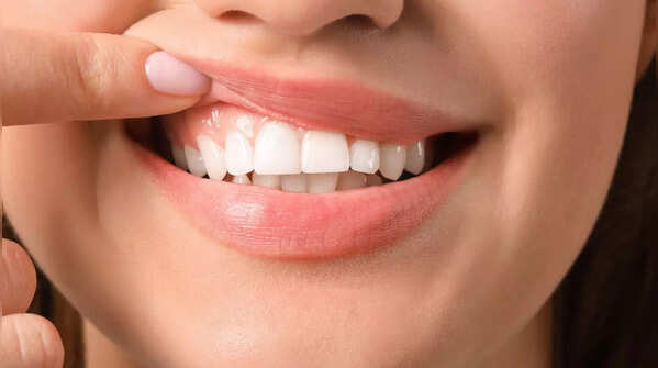 Oral signs that could point to magnesium deficiency