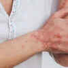 Skin and inflammatory issues