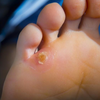 Corns and loss of natural grip