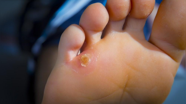 Corns and loss of natural grip
