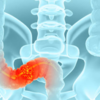 Colon cancer risk factors