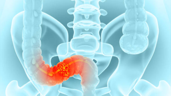 Colon cancer risk factors