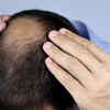 You can fight hair loss
