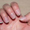 Nails that break and hair that thins 