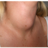 Lump or swelling in the neck