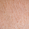 Flaky or peeling skin
