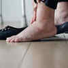 Swelling (edema) and sudden weight gain