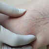 Small visible vessels on skin