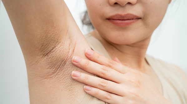 Persistent lump in the underarm