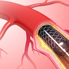 Early symptoms of PAD