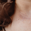 Nodules or lumps on the skin