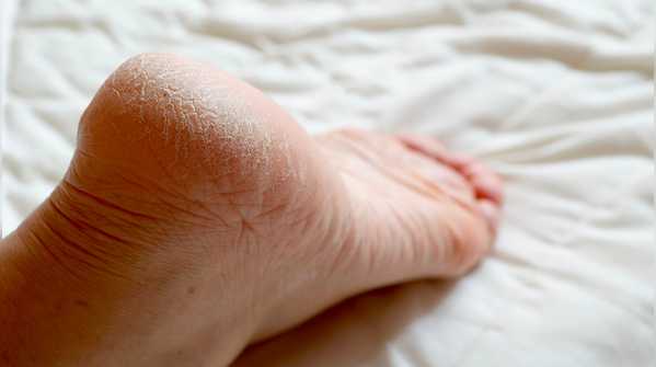 Heel pain hits young hardest