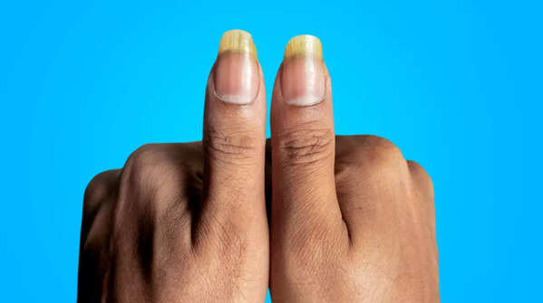 Yellow nails
