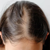 Article image for: Early signs of <i class="tbold">balding</i>
