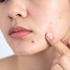 Hair fall, acne, irregular periods