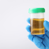 Dark yellow urine with strong odour