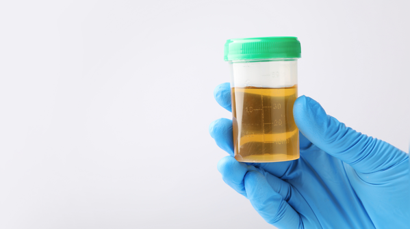Dark yellow urine with strong odour