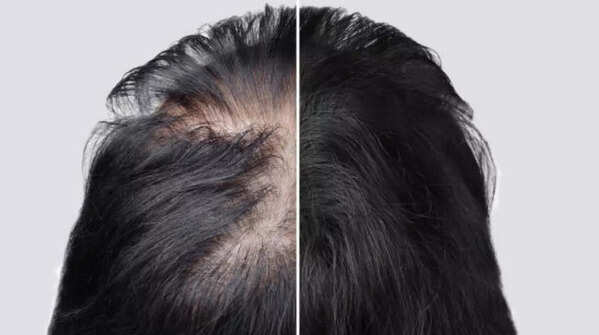 The truth about hair regrowth
