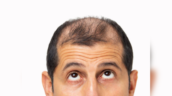 Why bald patches feel worse in summer
