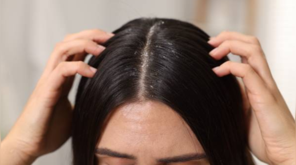 Cool your scalp before you try anything else