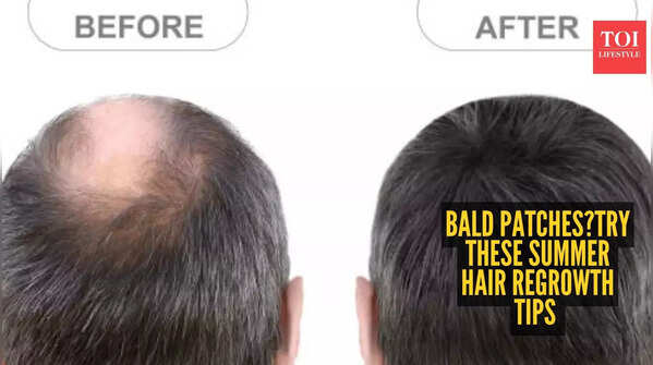 5 easy summer hair regrowth tips for bald patches