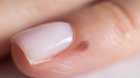 Brittle or ridged nails may reflect nutritional gaps or stress