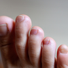 Clubbed nails can reflect heart or lung disease