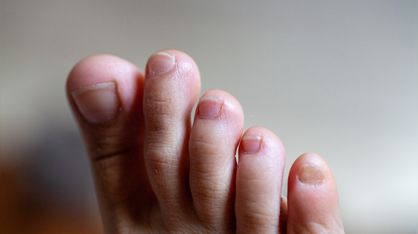 Clubbed nails can reflect heart or lung disease