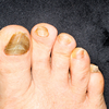 Yellow and thickened nails may point to infections or lung issues
