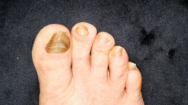 Yellow and thickened nails may point to infections or lung issues