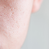 What are open pores?