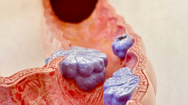 Why bowel habits matter more than people realise