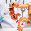 Why colon cancer is rising among younger adults