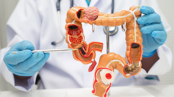 Why colon cancer is rising among younger adults