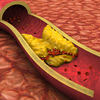 How Lipoprotein(a) damages the heart and arteries