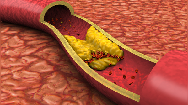 How Lipoprotein(a) damages the heart and arteries