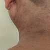 Article image for: More than diabetes, more than the neck: Where Acanthosis Nigricans can hide