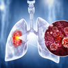 Tuberculosis is still one of the leading infectious killers, so why does awareness around tuberculosis remain low compared to other diseases?