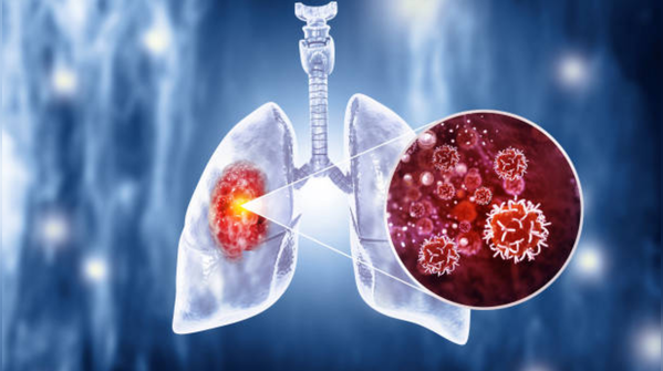 Tuberculosis is still one of the leading infectious killers, so why does awareness around tuberculosis remain low compared to other diseases?