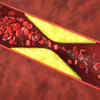 Lowers bad cholesterol