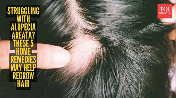 Home remedies that can actually help with hair regrowth in Alopecia Areata