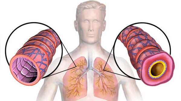 The ‘Emotional Asthma’ Theory