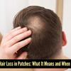 Article image for: Bald patch spotted? Act on it quickly!
