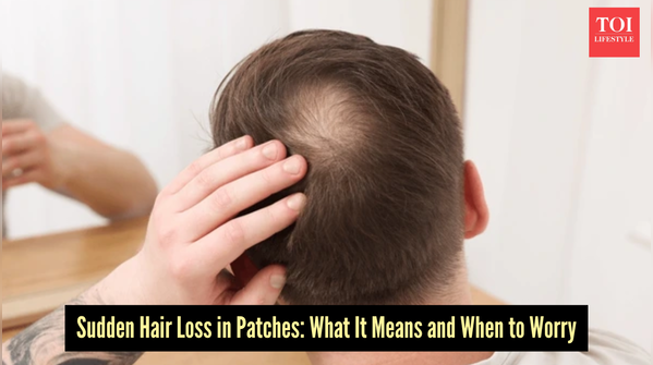 Bald patch spotted? Act on it quickly!