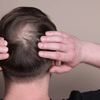 Autoimmune alarm: Alopecia areata